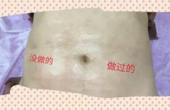 去妊娠紋機(jī)器多少錢一臺(tái)？美容院去除妊娠紋機(jī)器設(shè)備價(jià)格