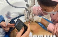 妊娠紋用什么儀器能去除？妊娠紋修復(fù)儀器廠家_最新祛妊娠紋的儀器